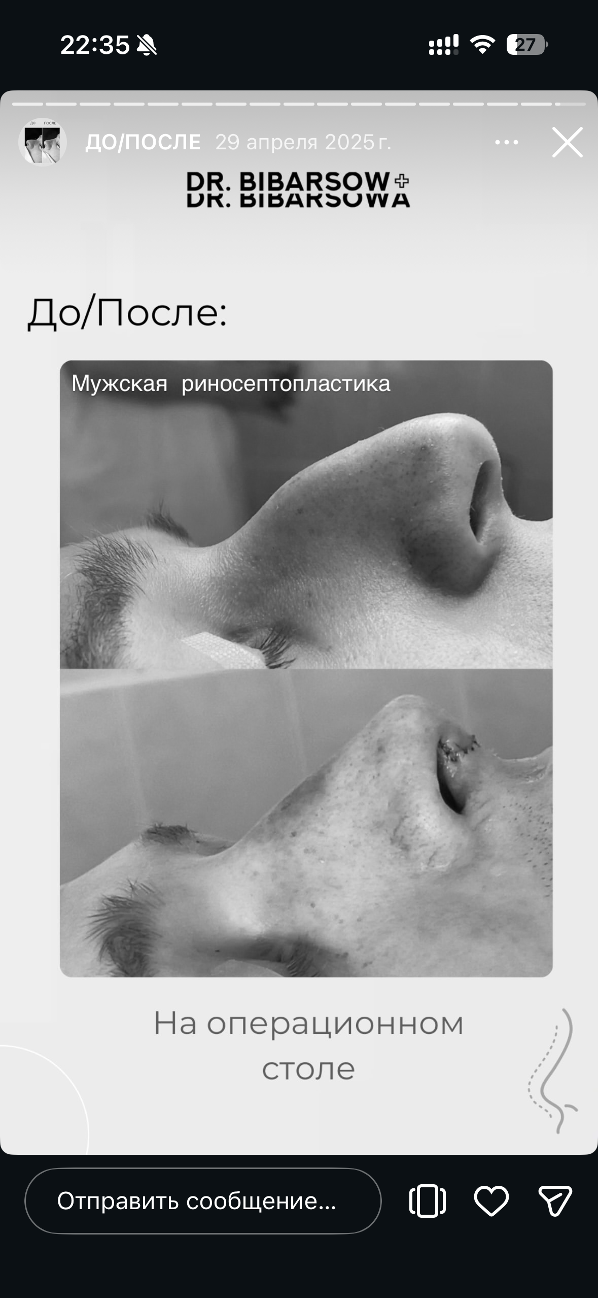 Мужская риносептопластика: фото до и после